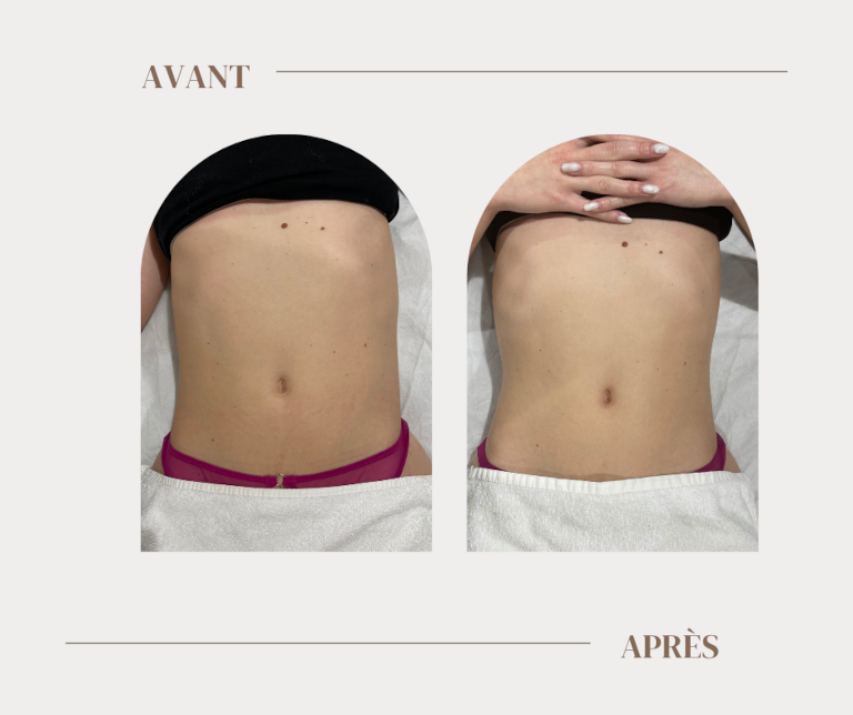 Résultats drainage lymphatique Renata França ventre face