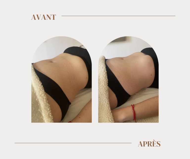 Résultats drainage lymphatique Renata França ventre profil