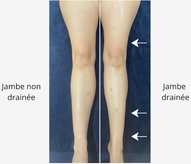 Résultats drainage lymphatique Renata França jambes femme