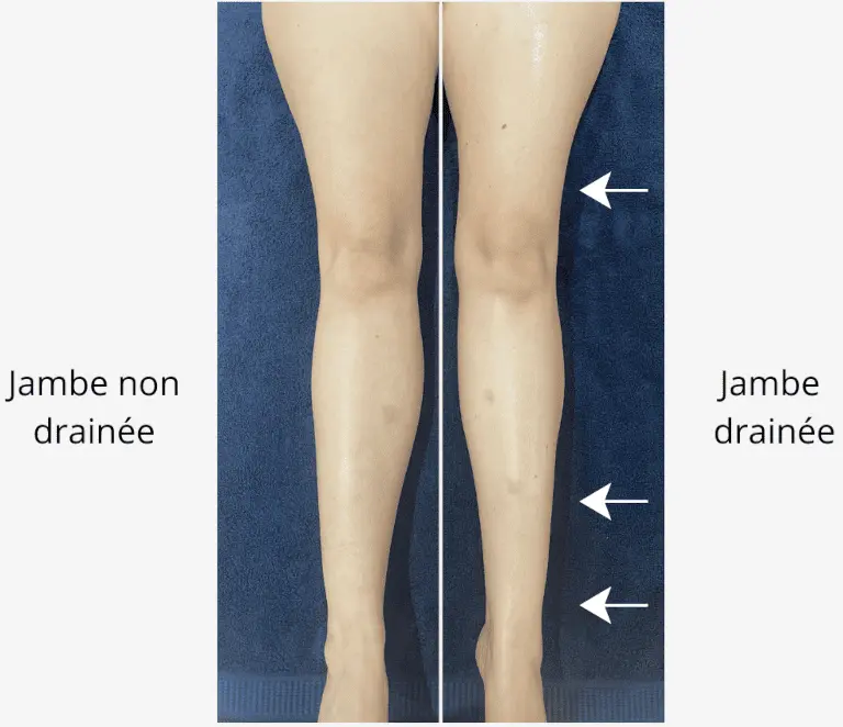 Résultat drainage lymphatique Renata França jambes femme