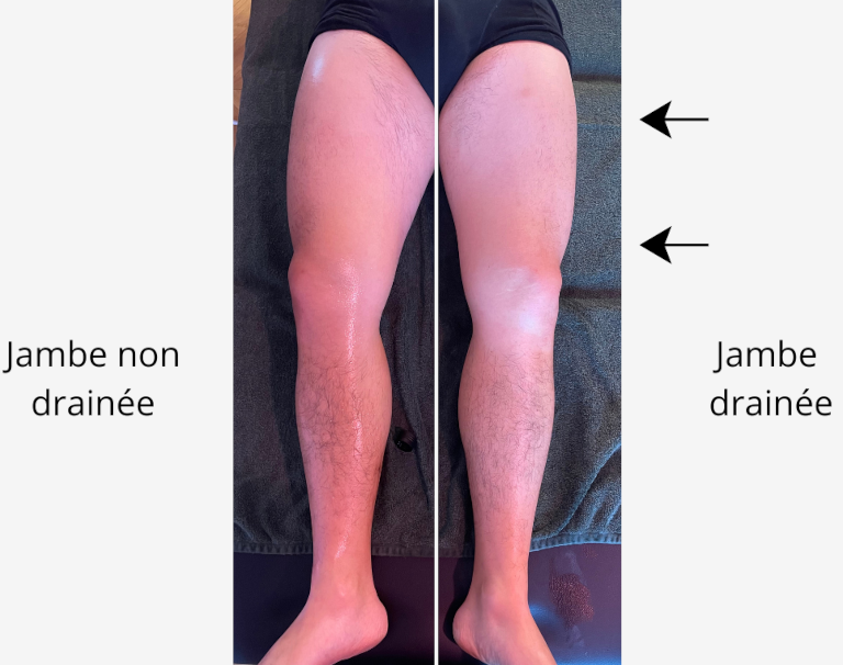 Résultats drainage lymphatique Renata França jambes homme